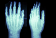 Hand & Upper Extremity Treatment in Las Vegas, NV